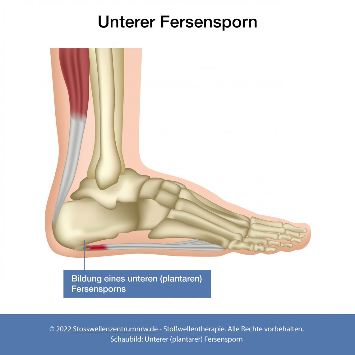 📶 Fersensporn zertrümmern mit Stoßwellen | Stoßwellenzentrum Köln