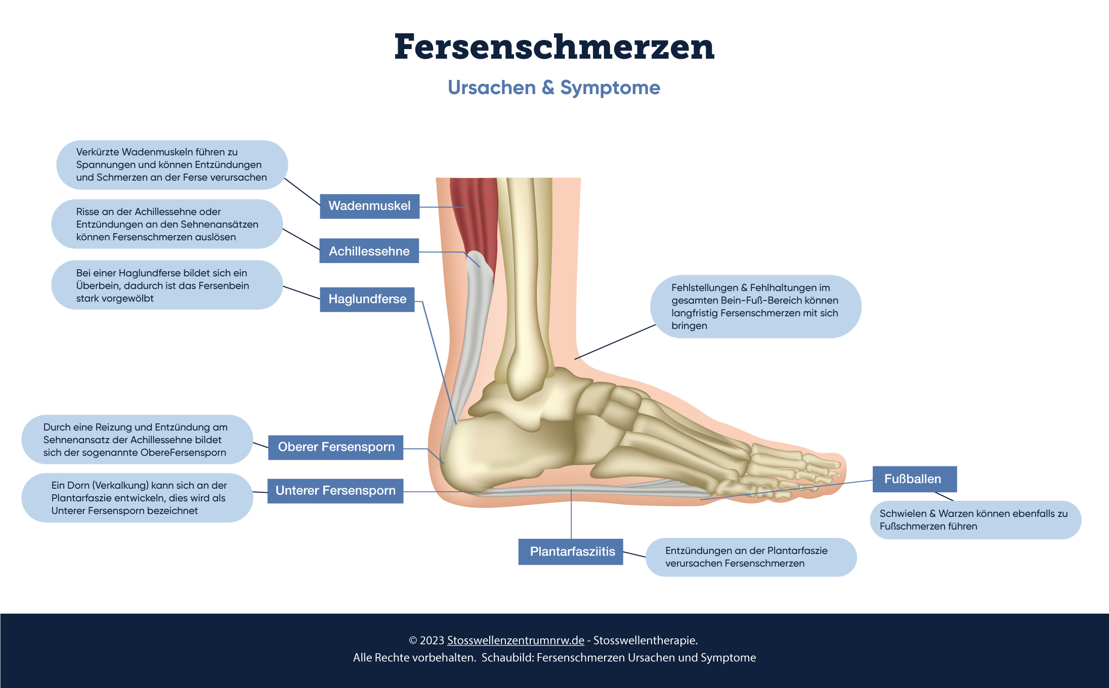 Fersenschmerzen Fersensporn Was Tun Sto wellenzentrum NRW Fersenschmerzen Fersensporn Was Tun Sto wellenzentrum NRW