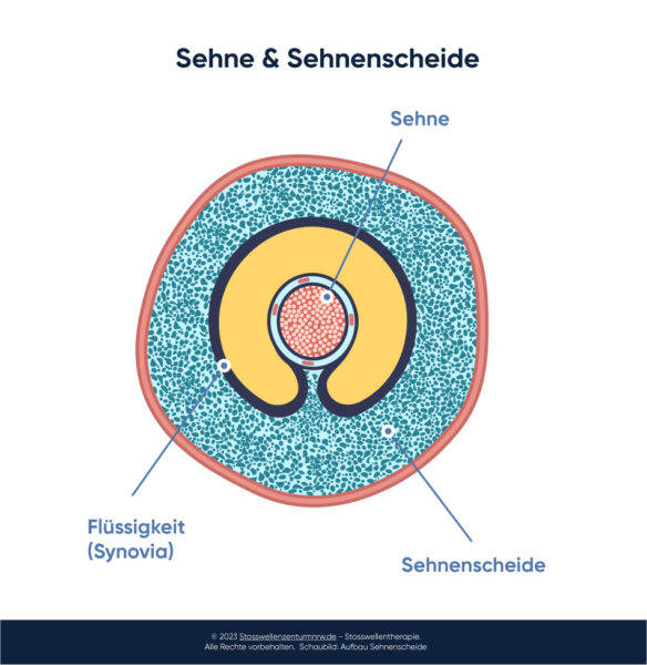 Sehnenscheidenentzündung Was hilft wirklich? Stoßwellenzentrum NRW