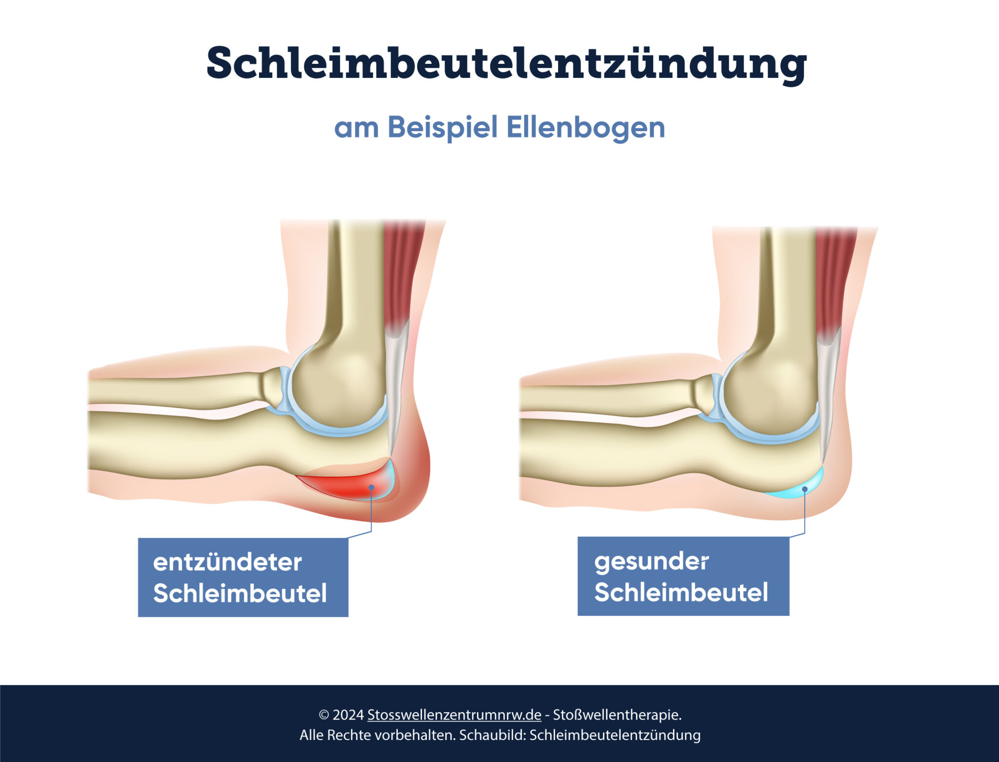 Was Tun Bei Schleimbeutelentzündung Ellenbogen stosswellenzentrumnrw.de
