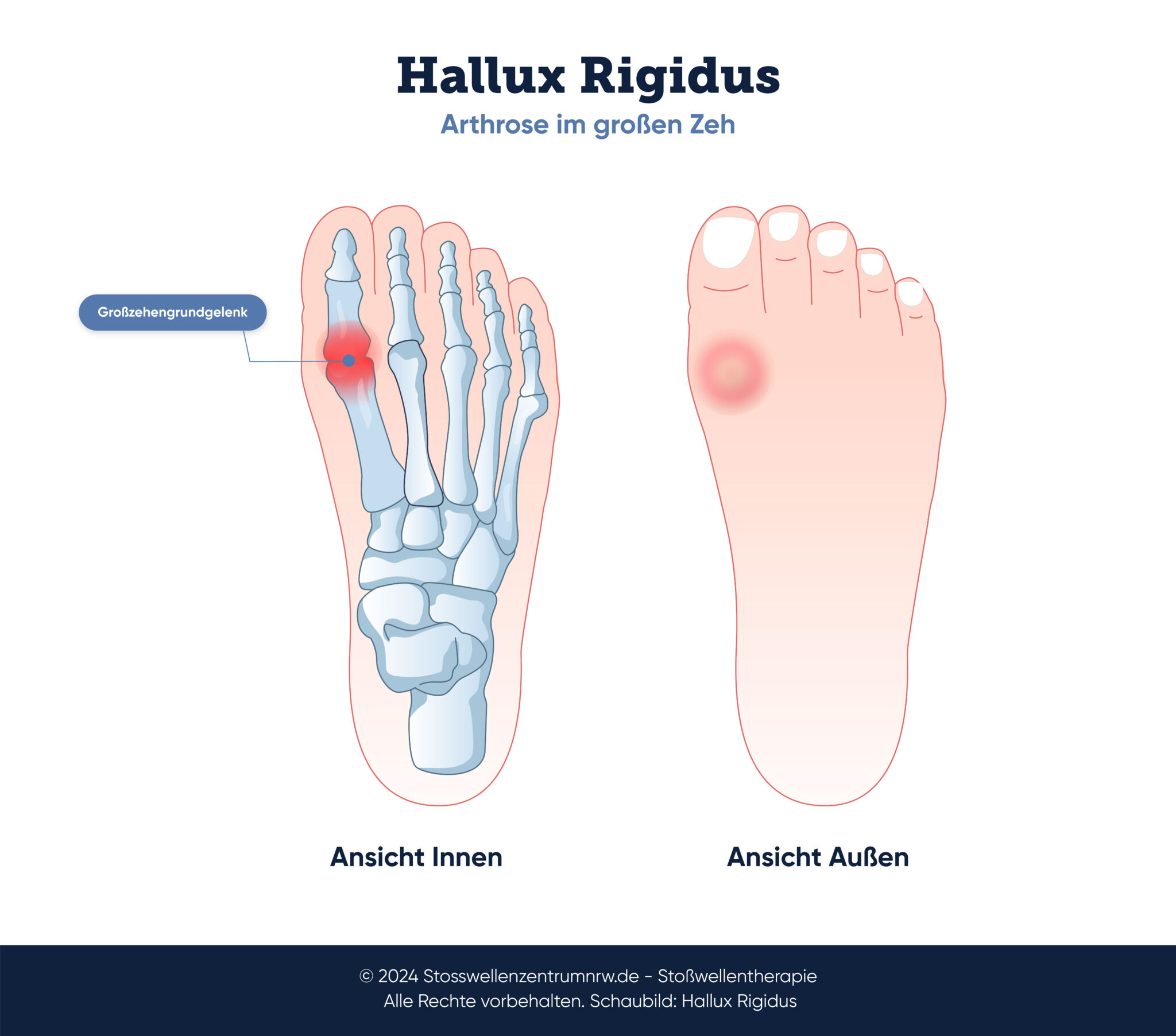 Hallux Rigidus - Was hilft bei Schmerzen am großen Zeh