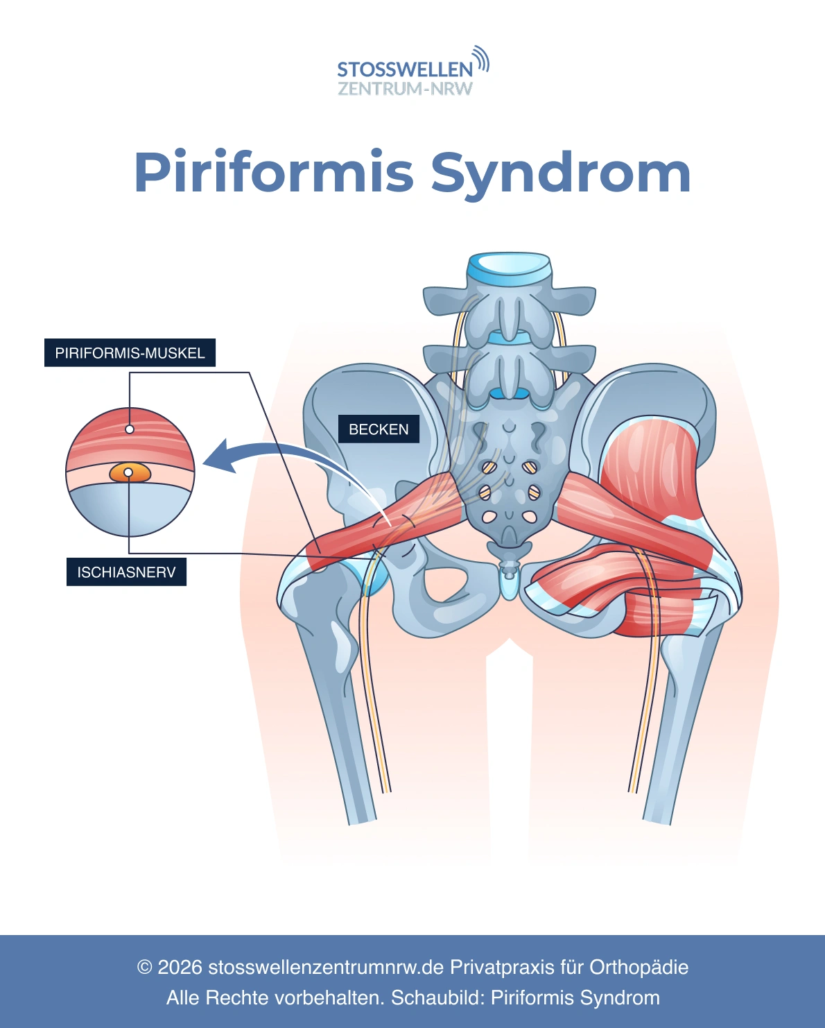 Schaubild-Piriformis-Syndrom-1 Schaubild Piriformis Syndrom – Stoßwellenzentrum NRW