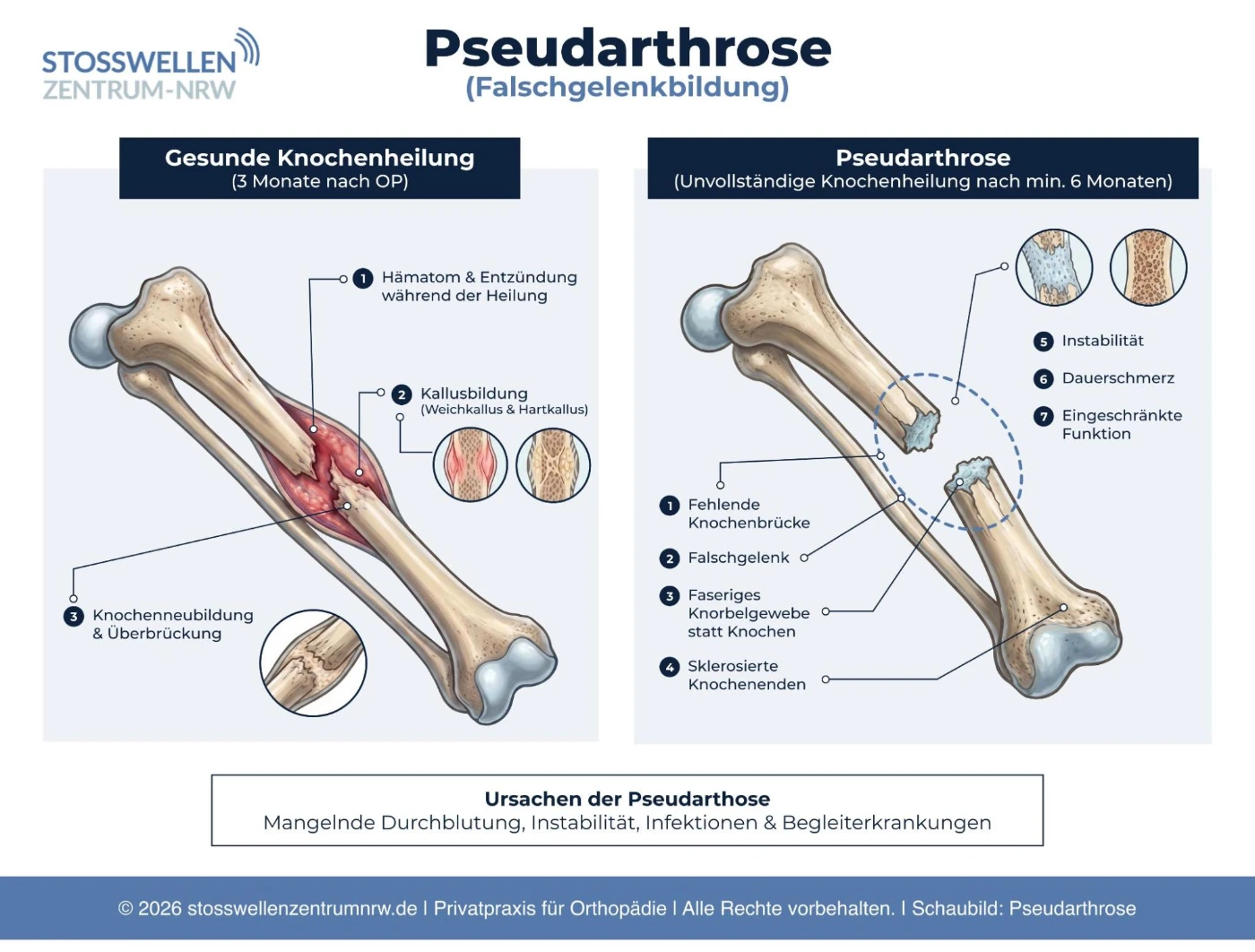 pseudarthrose-1